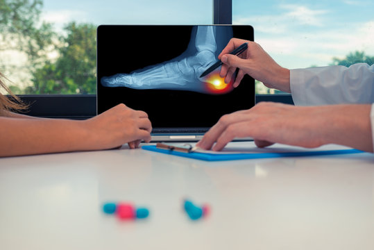 Doctor showing a x-ray of a foot and pain on the heel on a laptop to a woman patient. Pills on the desk