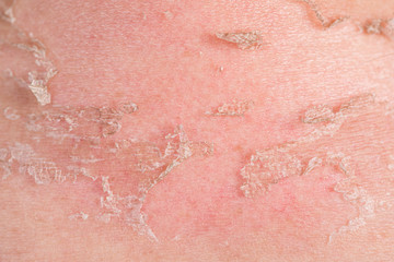Sunburns of body closeup. Skin damaged by sun, peeling. Body care theme