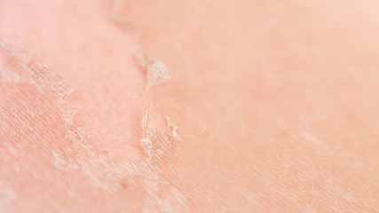 Sunburns of body closeup. Skin damaged by sun, peeling. Body care theme, Copy space