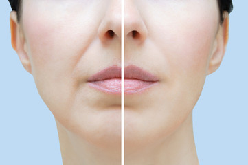Nasolabial folds in a Caucasian woman. Face close up. Before and after.