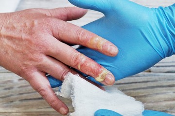 the doctor puts a bandage with the medicine on the burn of the fingers of the woman's hand, an...