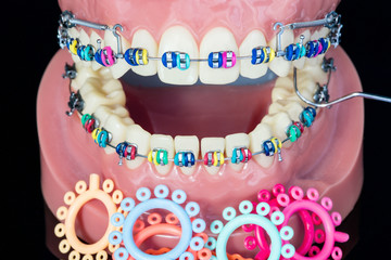Close up  orthodontic model  - demonstration teeth model of varities of orthodontic bracket or brace