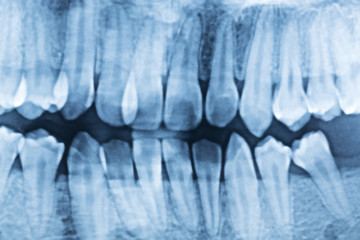 panoramic dental x-ray of a mouth left and right side.