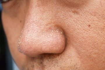 acne vulgaris on nose of asian man