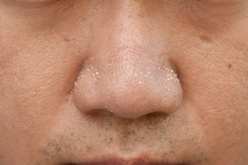 acne vulgaris on nose of asian man