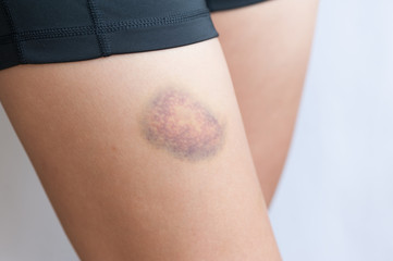 people with bruised leg closeup