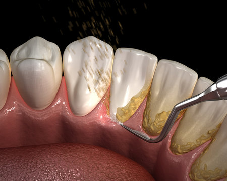 Oral hygiene: Ultrasonic teeth cleaning machine removing calculus and plaque. Medically accurate 3D illustration of human teeth treatment