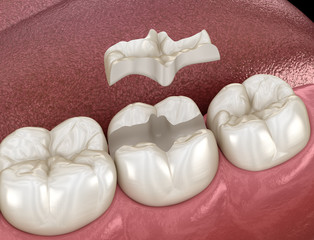 Inlay ceramic crown fixation over tooth. Medically accurate 3D illustration of human teeth treatment