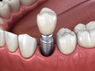 Premolar tooth recovery with implant. Medically accurate 3D illustration of human teeth and dentures concept