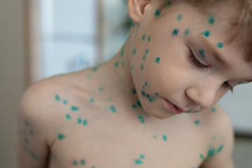 Portrait of little boy, kid with chickenpox, back with rash and blisters.