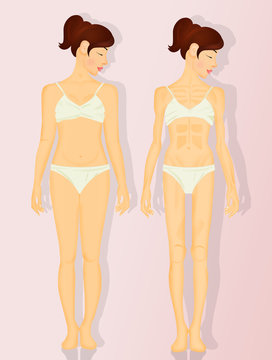 illustration of anorexia