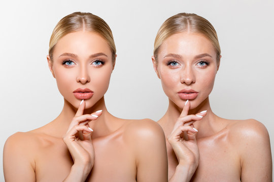 Young Woman with Acne Skin. Beautiful Girl touching her Face with her hand, Portrait before and after skin treatment of pimples. Over gray background. - Image