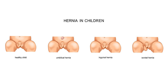 Hernia In Children.