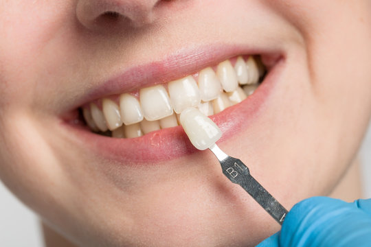 dentist using a shade guide at woman's mouth to check veneer of tooth