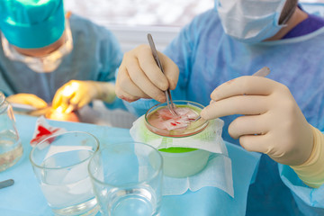 Baldness treatment. Hair transplant. Surgeons in the operating room carry out hair transplant...
