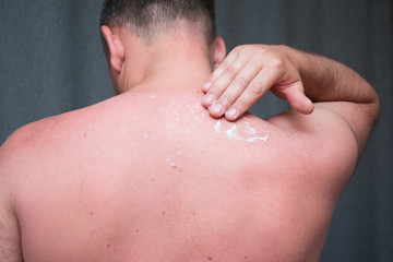 A man with reddened itchy skin after sunburn, smears cream on the skin. Skin care and protection from the sun's ultraviolet rays. 