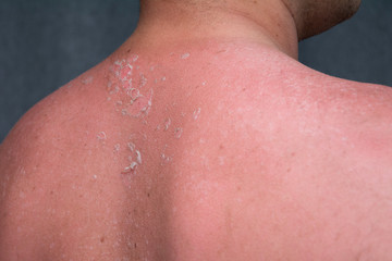 peeling skin at back and shoulder from sunburn effect on body of young man from sunbath at summer. dangerous sunburn concept 