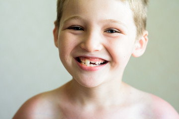 The boy's teeth are falling off and decaying.