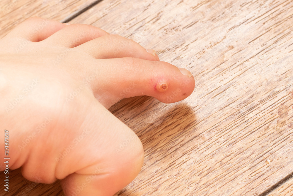 Canvas Prints closeup of foot with an infected wart placed on toe. foot wart. foot bottom pathology: verruca, wart