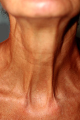 Wrinkles on the neck. Flabby skin on the neck.