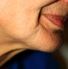 Fototapeta premium Sunken cheeks. Nasolabial folds on face. Wrinkles.