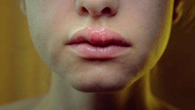 Herpes on the Upper Lip of a Young Woman. Medical Background of a Young Beautiful Woman with Herpes Labialis. Herpes Simplex Virus. Tilt Up