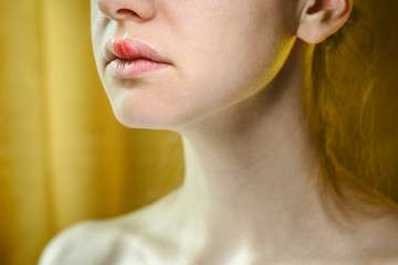 Herpes on the Upper Lip of a Young Woman