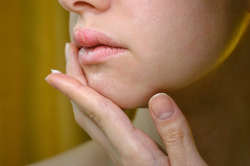 Herpes on the Upper Lip of a Young Woman