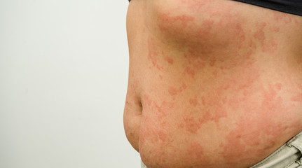 Urticaria.