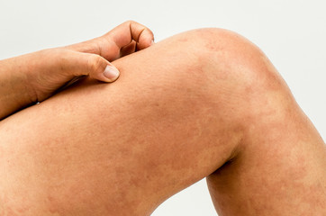 Urticaria.