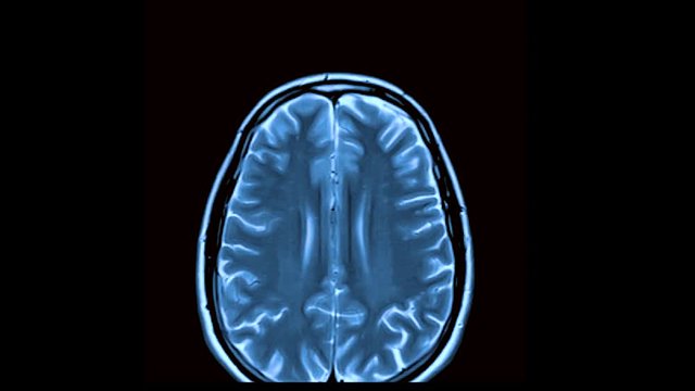 MRI timelapse brain scan,magnetic resonance imaging of a brain, ultra hd 4k, time lapse