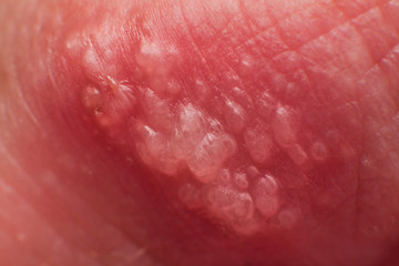 Beginning of growing herpes on caucasian male man on front upper lip super macro microscope