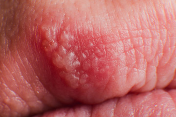 Beginning of growing herpes on caucasian male man on front upper lip super macro microscope