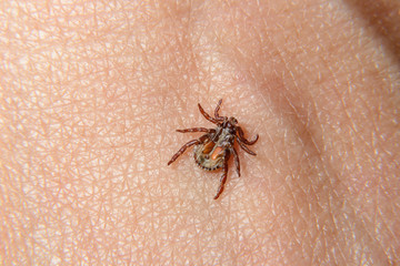 Forest mite on the skin. wood tick