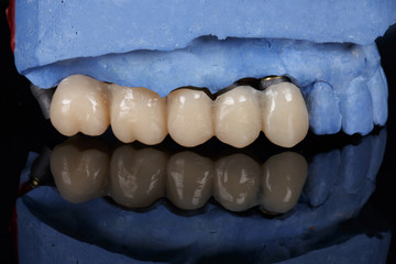 Dental temporary prosthesis from a polymer on a black mirror