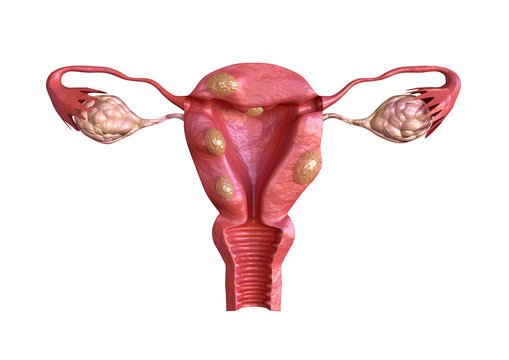 uterine fibroid are benign solid tumors formed by muscle tissue. Its size can vary greatly and some cause large abdomen increase