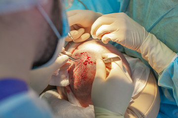 Baldness treatment. Hair transplant. Surgeons in the operating room carry out hair transplant...