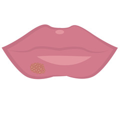 Herpes on lips cold sores viral infection