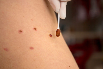Skin scars from laser removal of moles.