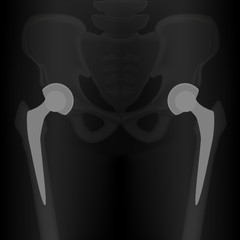 Vector illustration x-ray Pelvis and Hip joint, Bilateral hip replacement. For advertisement and medical publications.