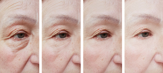 elderly woman face wrinkles before and after treatmentм