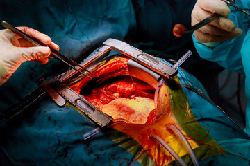 Heart surgery in the surgical operating room