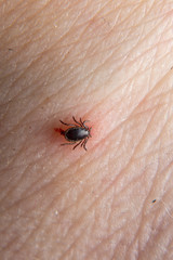 Hazardous mite, a Lyme Disease carrier bites a person.