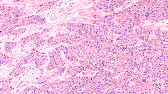 Microscopic image of invasive squamous cell carcinoma of the vulva, related to human papilloma virus (HPV).  HPV vaccination in teens can prevent HPV infections, cervical and vulvar cancer.