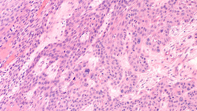 Microscopic image of invasive squamous cell carcinoma of the vulva, related to human papilloma virus (HPV).  HPV vaccination in teens can prevent HPV infections, cervical and vulvar cancer.