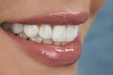 beautiful smile and veneers of young woman close up