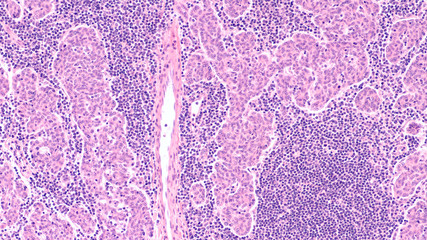 Microscopic image (photomicrograph) of a thymoma, a tumor of thymic gland origin with both epithelial and lymphoid components.  It may be seen in association with myasthenia gravis.