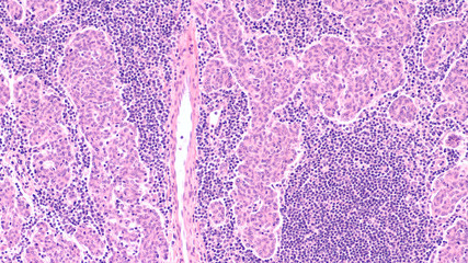 Microscopic image (photomicrograph) of a thymoma, a tumor of thymic gland origin with both...