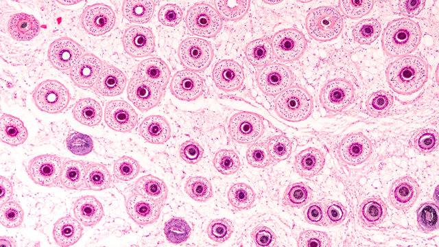 Photomicrograph of the human scalp, showing histology of hair follicles, cut as a tangential cross section.  