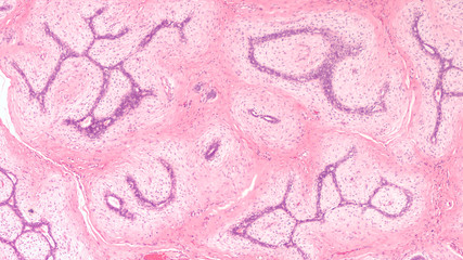Breast Biopsy: Microscopic image (photomicrograph) of a fibroadenoma, a benign circumscribed tumor composed of both glandular and stromal tissue.